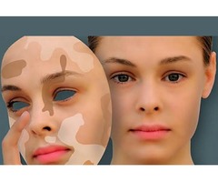 Acne Scars Treatment Jaipur